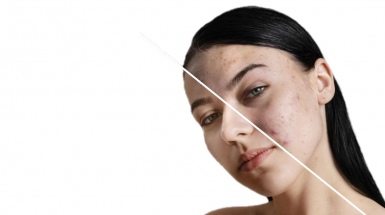 Удаление рубцов постакне на коже