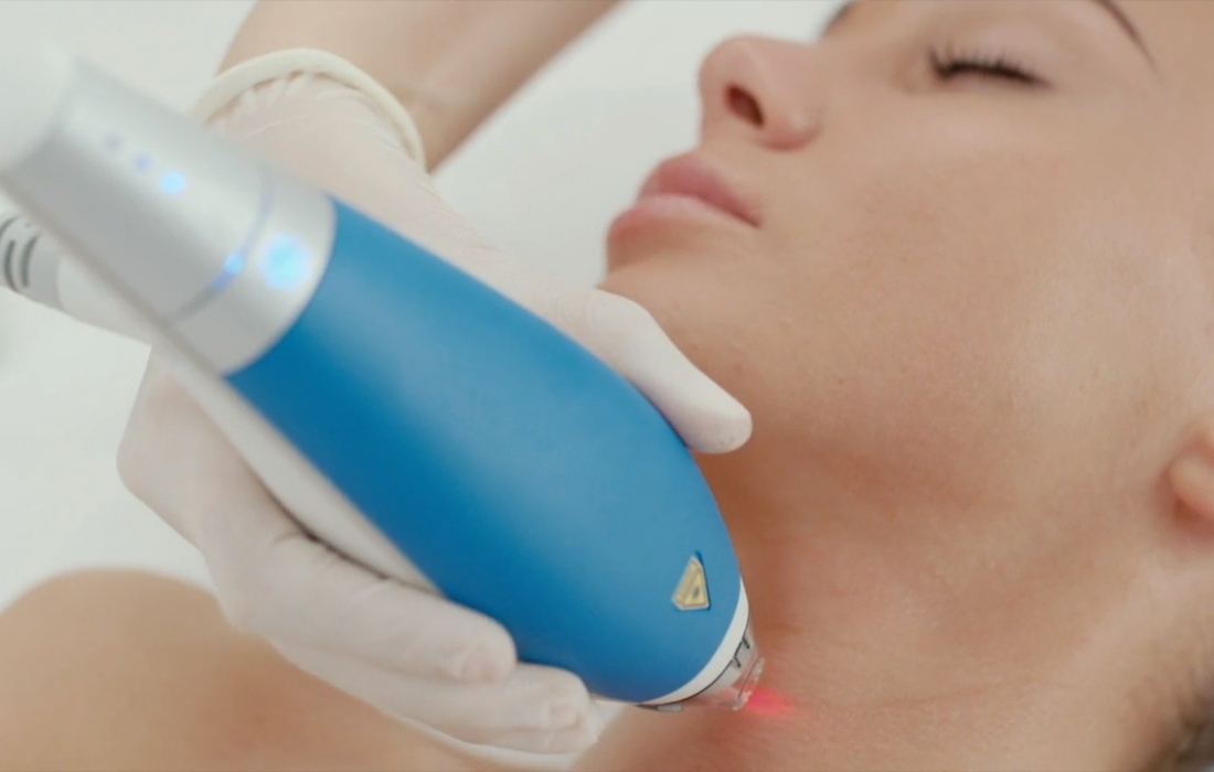 Лазерный пилинг лица Clear+Brilliant