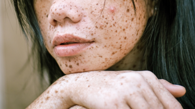 Удаление пигментных пятен