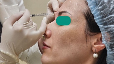 Контурная пластика лица для восстановления объема тканей