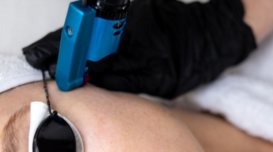 Услуга лазерного удаления татуажа