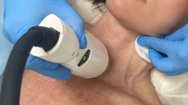 Радиочастотный RF лифтинг - Infini