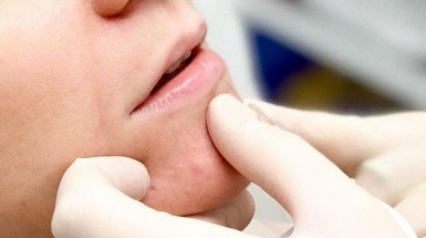 Увеличение губ гиалуроновой кислотой