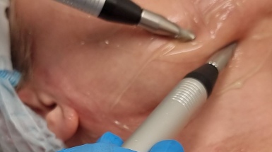 Микротоковая терапия