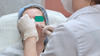 Коррекция выраженных мимических морщин
