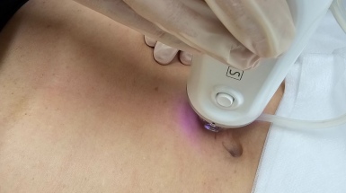 RF-лифтинг для устранения дряблости кожи шеи и лица