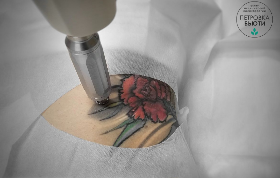 Удаление тату лазером