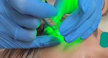 Удаляем новообразования с косметологом Моргоевой Софией