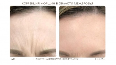 Морщины межбровки