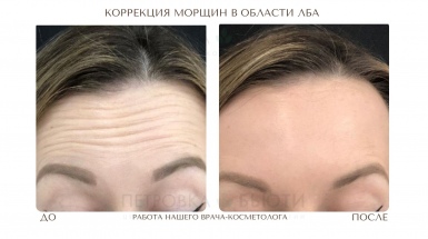 Морщины лба