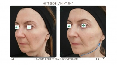 Нитевой лифтинг