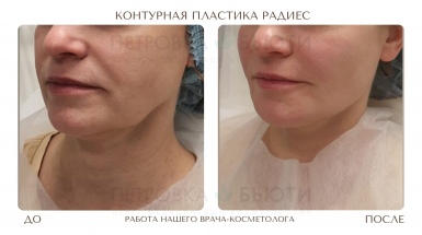Радиес контурная пластика