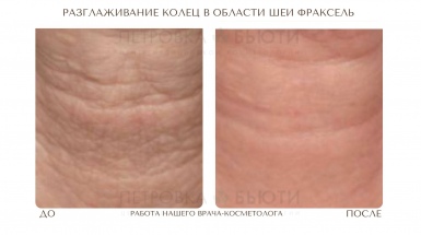 Фраксель шея