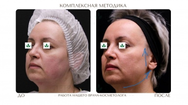 Комплексная коррекция