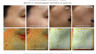 Ретиноловый пилинг