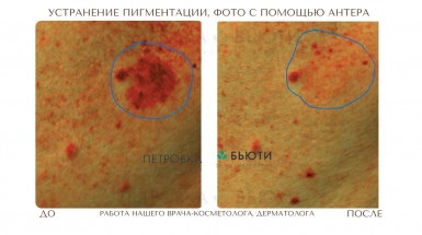 Устранение пигмента