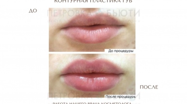 Контурная пластика губ