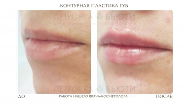 Контурная пластика губ