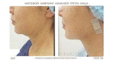 Увеличение губ