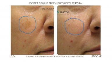 Устранение пигментации