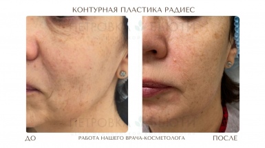 Контурная пластика