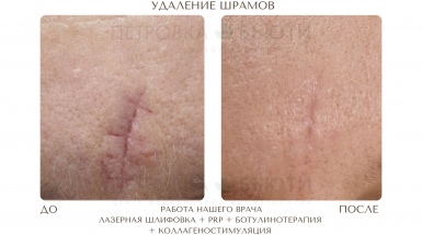 Устранение рубцов и шрамов