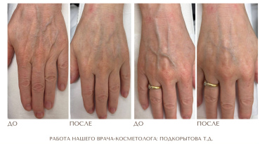 Омоложение рук с косметологом Подкорытовой Татьяной