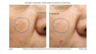 Устранение пигмента