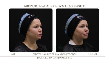 Биоревитализация