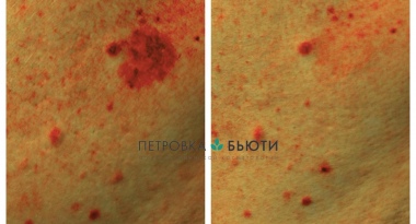 Устраняем пигмент с косметологом Громыко Наталией