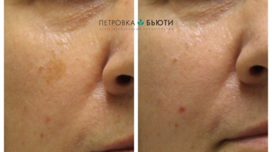 Лечение сильной пигментации