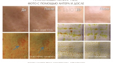 Ретиноловый пилинг