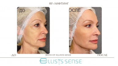 Аппаратный rf-лифтинг кожи лица