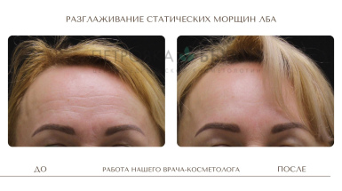 Устранение пигмента